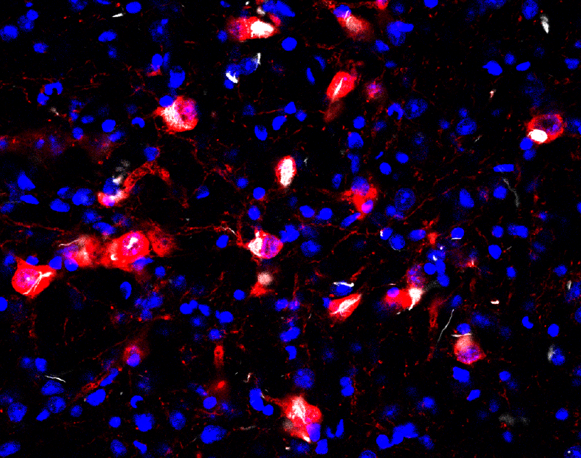 Parkinson's disease pathology Alpha-synuclein pathology in cholinergic pedunculopontine neurons image