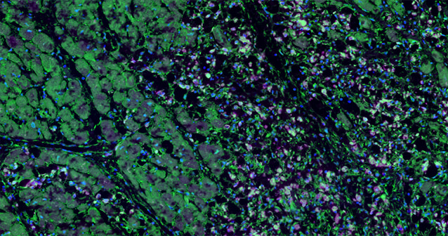 Activation of hypoxia inducible factors (green) in macrophages (purple) that have infiltrated damaged cardiac tissue (right) in heart tissue