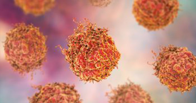 Medical illustration of prostate cancer cells