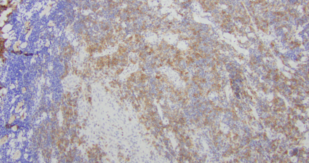 Immunohistochemistry staining showing PD1 expression on tumor cells in a skin biopsy from a cutaneous T-cell lymphoma patient.Picture