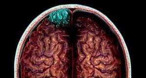brain scan of brain with tumors