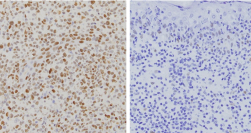 Picture of Tumor skin biopsy from two different patients. One patient who has a JAK2 gene fusion is positive for pSTAT3 staining, a marker of activated JAK-STAT signaling (left). Another patient who lacks the JAK2 gene fusion is negative for pSTAT3 (right). The patient with the JAK2 fusion is predicted to have good response to JAK2 inhibitors.