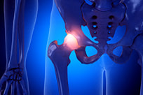 Orthopaedics illustration of hip joint and bone