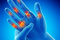 Rheumatology illustration of finger joints