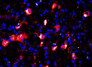 Alpha-synucleain pathology in cholinergic pedunculopontine neurons
