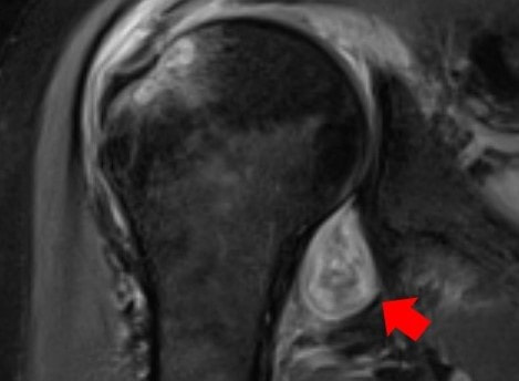 MRI of shoulder