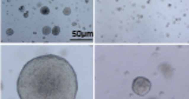 Patient-derived prostate cancer cells (left) with high FOXA1 grow large, but the dual-inhibitor therapy reduced their growth considerably (right).